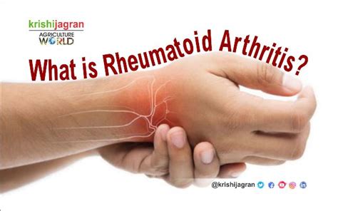 Rheumatoid Arthritis Early Signs Symptoms And Treatment