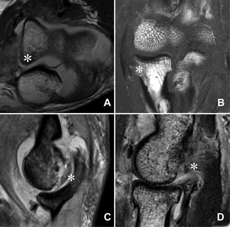 Distribution Of Osteochondral Lesions In Patients With Simple Elbow