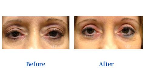 Oculoplastic Surgery Before And After Gallery Eye Surgery Associates