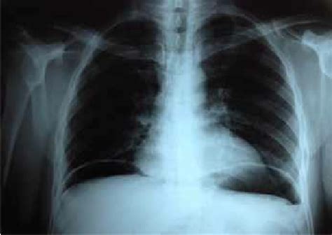 Chest X Ray Showing Air Under Both Diaphragms Confirming The Presence