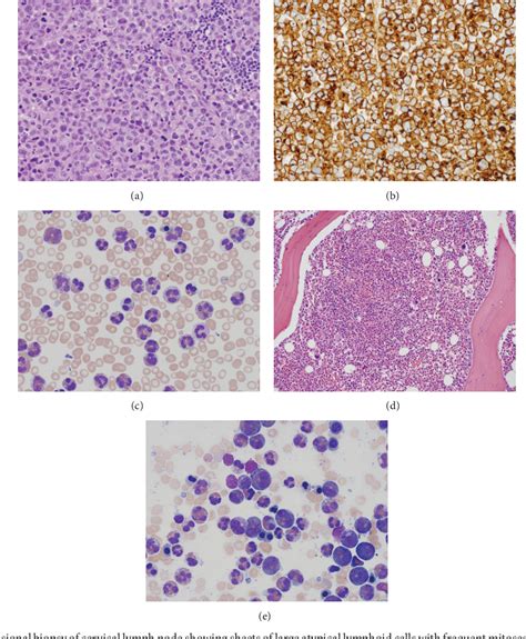 Figure 1 From Chronic Eosinophilic Leukemia—not Otherwise Specified