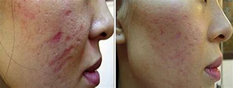 Pitted Scars Treatment In Kullu Dhalpur By City Hospital Id 7279520155