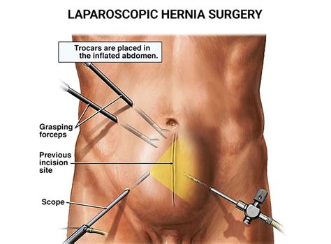 Laparoscopic Hernia Surgery New Jersey Top Nj Hernia Specialists