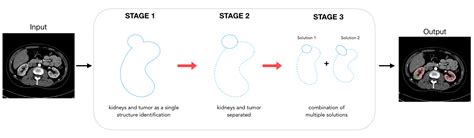 Ai In Medical Imaging The Kidney Tumor Segmentation Challenge