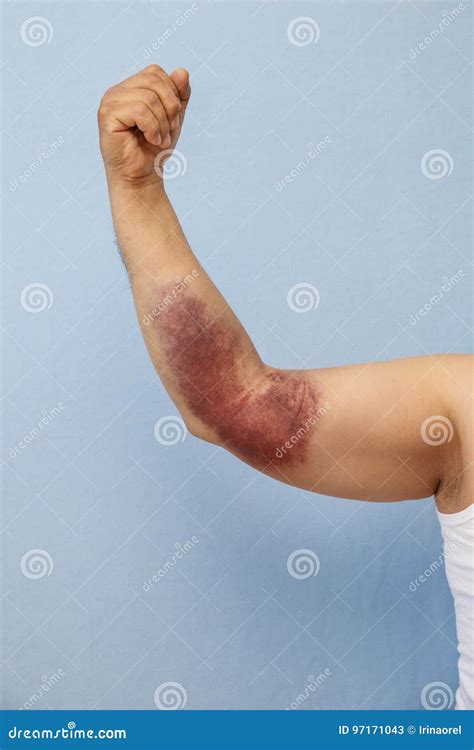 Man`s Hand With Hematoma Stock Image Image Of Bruising 97171043