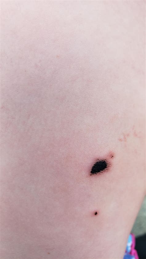 What Are These Black Spots On My Daughters Leg Dermatologyquestions