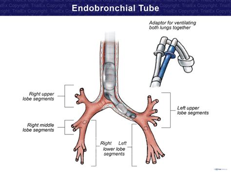 Endobronchial Tube Trialexhibits Inc