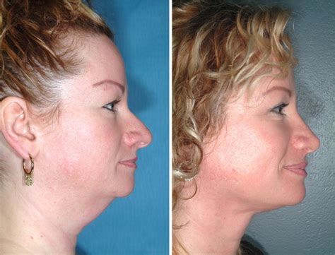 Lose That Turkey Neck By Jowl Liposuction In Beverly Hills