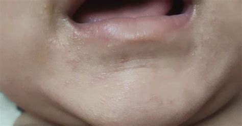 My Son Has These Small Bumps Around Mouth Onlyits Not Spreading