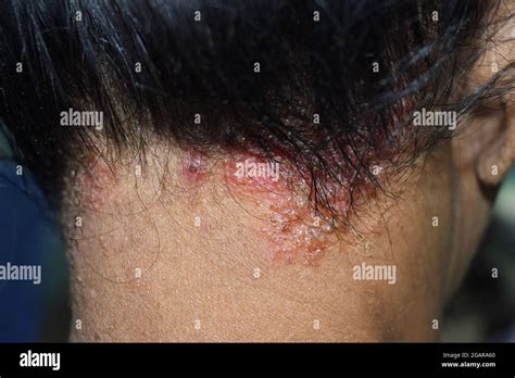 Seborrheic Dermatitis Or Fungal Skin Infection At The Scalp Of