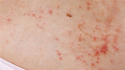 Red Spots On The Skin Philadelphia Holistic Clinic Dr Tsan And Assoc