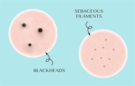 Sebaceous Filaments And Blackheads Know The Difference Tropic Skincare