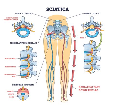 What Is Sciatica Types Of Sciatica Treatment Premia Spine Blog