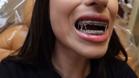 Braces Girlswithbraces Metalbraces Elastics Powerchain Braces Rubber Bands Dental Braces