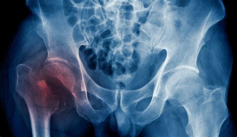 Study Hip Fracture Burden To Nearly Double Worldwide By 2050 Harvard