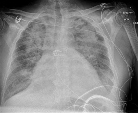 Pulmonary Edema Chest X Ray