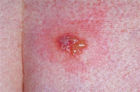 Herpes Simplex Lesion On The Skin Photograph By Dr P Marazziscience