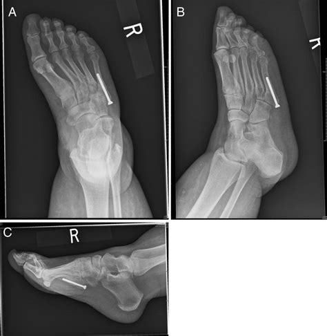 Treatment Of Jones Fracture Nonunion With Isolated Intramedullary Screw