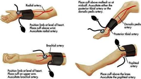 The Normal Blood Pressure In The Lower Limbs Reads Higher Than That Of
