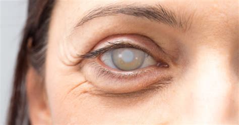 Find out the symptoms of cataracts, cataract surgery, and how to prevent cataracts. Cataract surgery complications - AllAboutVision.com
