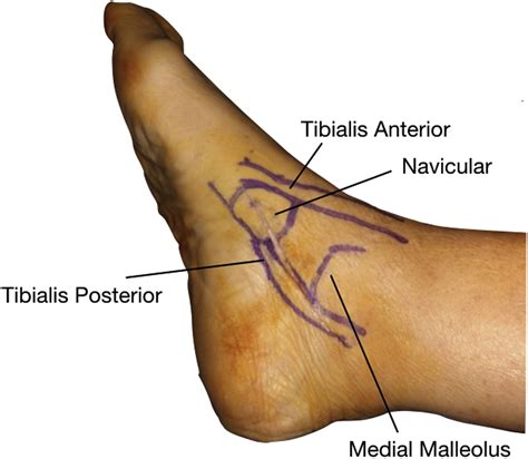 Medial Approach To The Subtalar Joint Foot And Ankle Clinics
