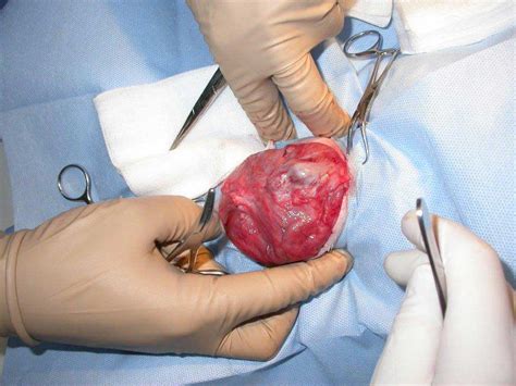 Epigastric Hernia Surgery Admitteddesign