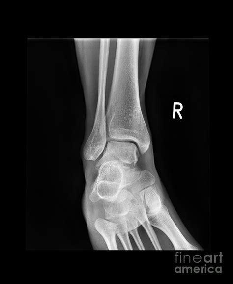 Ankle Bone Fracture X Ray Photograph By Science Photo Library Pixels