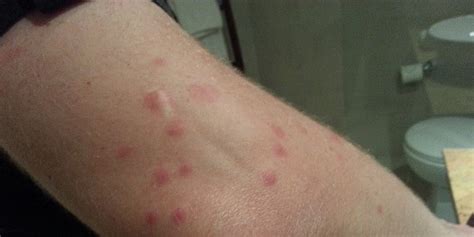 Find out about the brown recluse spider, black widow, and other spiders most spiders are harmless and will bite only if they feel threatened. Mosquito Bites Or Bed Bug Buffet? | LoyaltyLobby