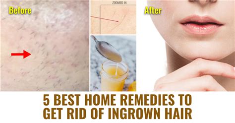 All You Need To Know About Ingrown Hair