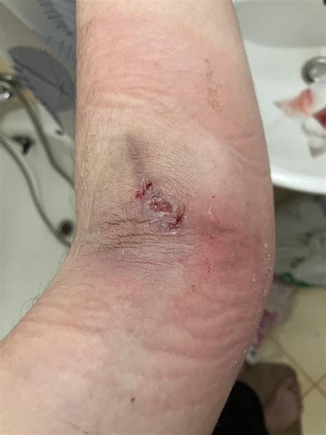 missed my vein while injecting oxycodone (abscess aftermath) : r