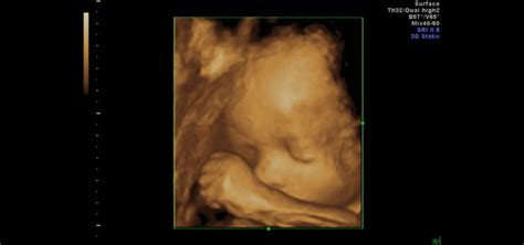Fetal Imaging Using 3d Ultrasound Cincinnati Childrens Blog