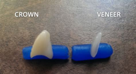 Dental insurance covers about 50% of the cost of the crown is needed for dental reasons. Veneers vs Crowns: Cost and Durability - Headgear Braces
