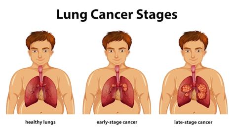 Premium Vector Lung Cancer Concept Four Stages Of Lung Cancer Disease