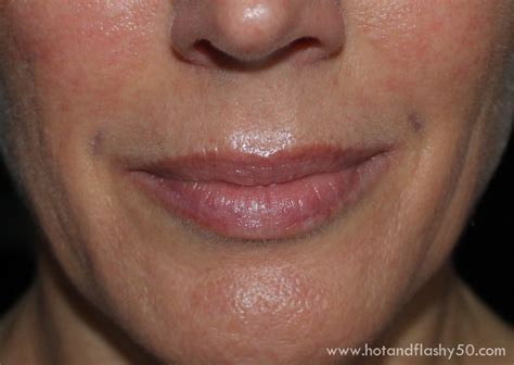 My Experience With Filler Juvederm And Botox