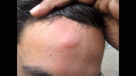 Bump On The Back Of My Head Lump On Back Of Head Caus