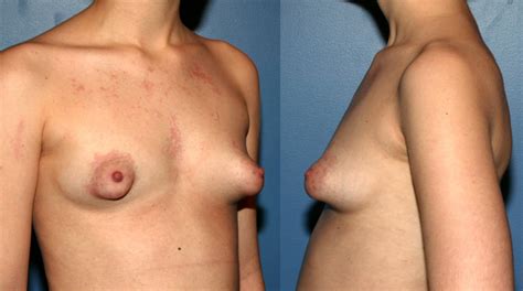 Puffy And Malformed Tits Lovely Areolas Plastic Surgery Pics