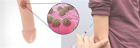 A prospective study in spain // bmc infect. Auch Jungen gegen HPV impfen! - Medical Tribune
