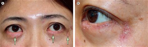 Persistent Red And Swollen Eyelids The Lancet