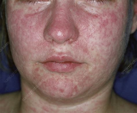 Measles Rash Stock Image C0529800 Science Photo Library