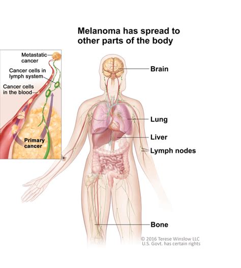 Melanoma Treatments With KEYTRUDA Pembrolizumab Advanced Melanoma Adjuvant Treatment Patients