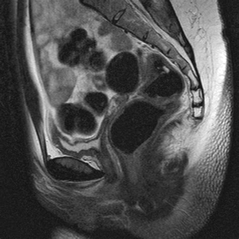 Affected women usually do not have menstrual periods. Mayer-Rokitansky-Küster-Hauser syndrome | Image ...
