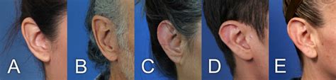 Learn What Macrotia Is By Dr Hilinski World Expert In Making Ears
