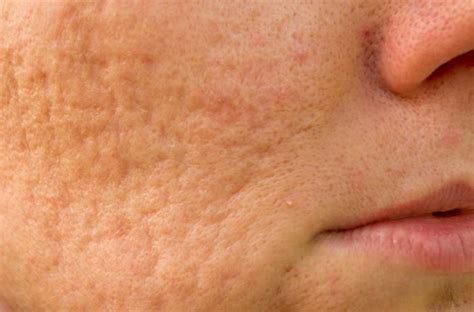 Cystic Acne Causes Symptoms Treatments Medical News Today