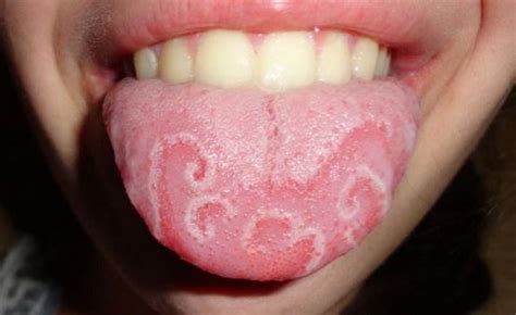 Burning Tongue Symptoms Causes And Other Risk Factors