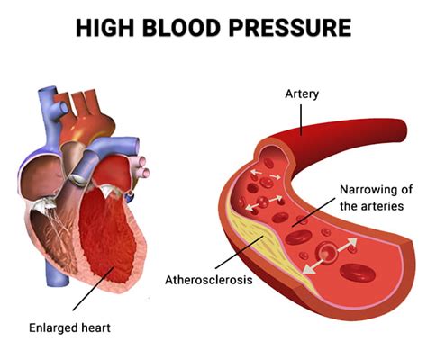 High Blood Pressure Understanding Blood Pressure Bp Readings