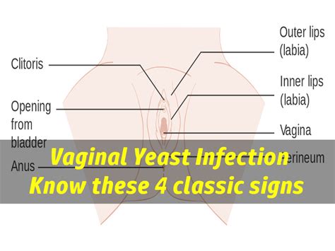 What Does A Yeast Infection Look Like The 4 Classic Signs To Look For