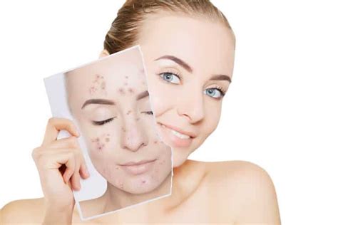 Face Masks Causing Acne Learn How Facials Can Help Your Skin