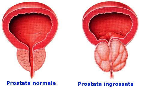 Prostatite Sintomi Cause E Cure Informazioni Mediche