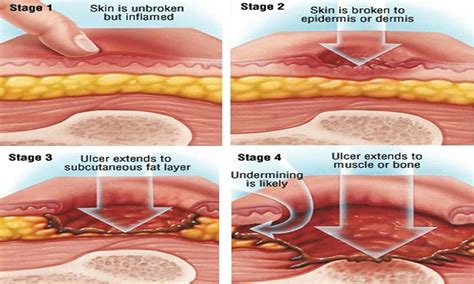 Stage Ulcer Ppt Pressure Ulcers In The Critically Ill Patient