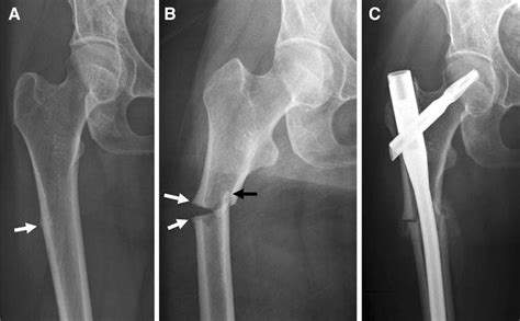 75 Year Old Woman With An Atypical Subtrochanteric Fracture Related To